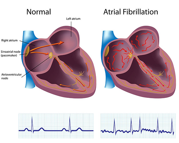 graphic comparing afib heart with normal heart